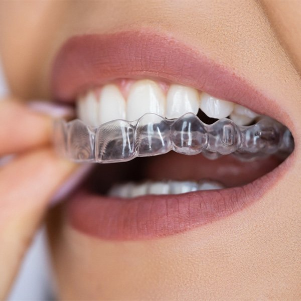 aligner-methoden-kieferorthopaedie-behandlung-praxis-am-fronwagplatz-zahnarzt-schaffhausen