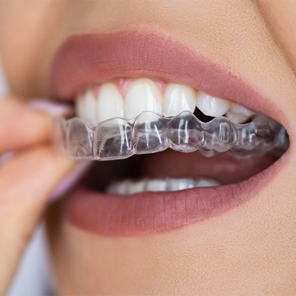 invisalign-methoden-kieferorthopaedie-behandlung-praxis-am-fronwagplatz-zahnarzt-schaffhausen